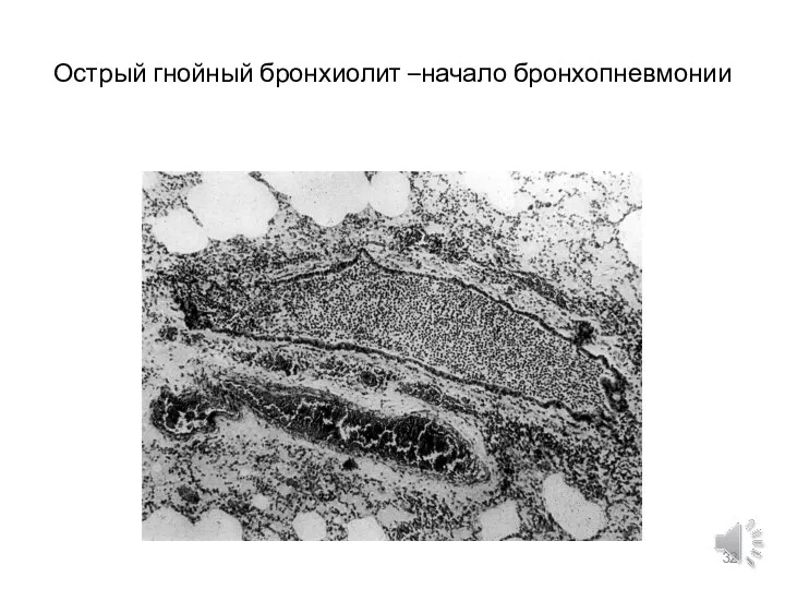 Острый гнойный бронхиолит –начало бронхопневмонии