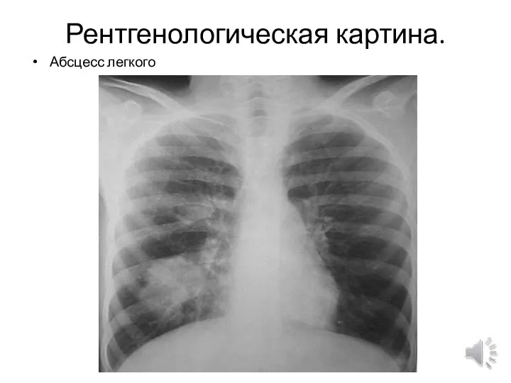 Рентгенологическая картина. Абсцесс легкого