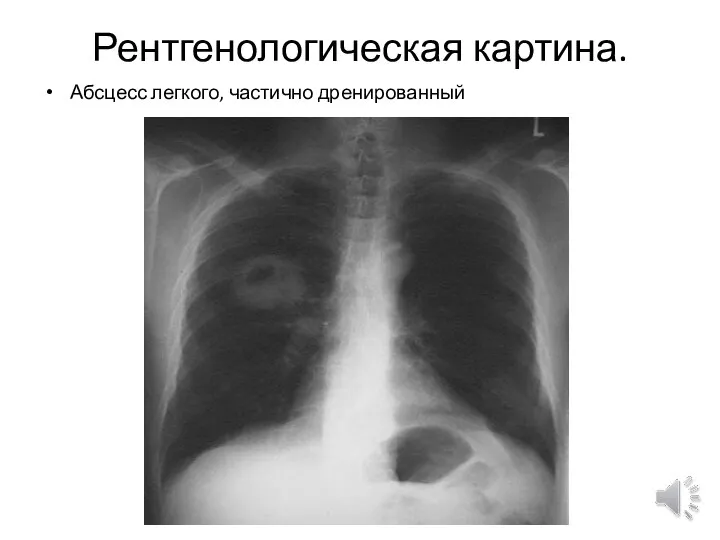 Рентгенологическая картина. Абсцесс легкого, частично дренированный