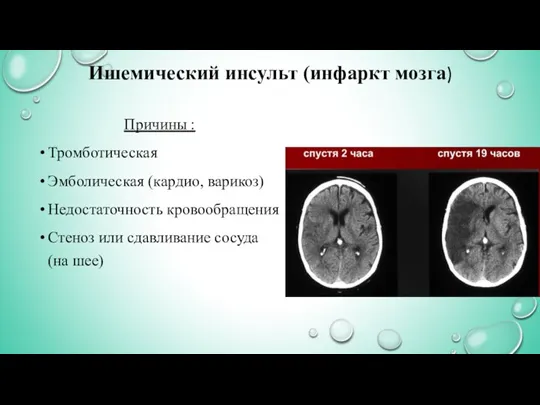 Ишемический инсульт (инфаркт мозга) Причины : Тромботическая Эмболическая (кардио, варикоз) Недостаточность кровообращения