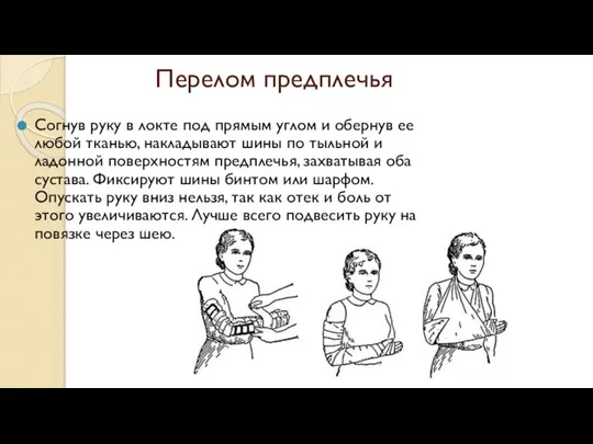 Перелом предплечья Согнув руку в локте под прямым углом и обернув ее