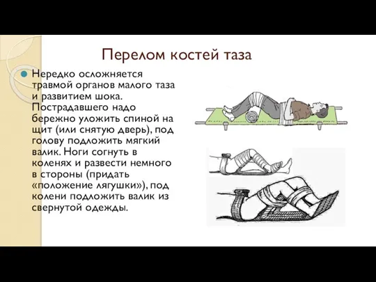 Перелом костей таза Нередко осложняется травмой органов малого таза и развитием шока.