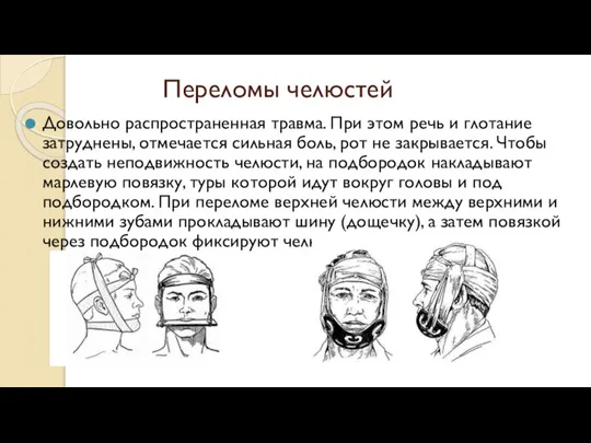 Переломы челюстей Довольно распространенная травма. При этом речь и глотание затруднены, отмечается