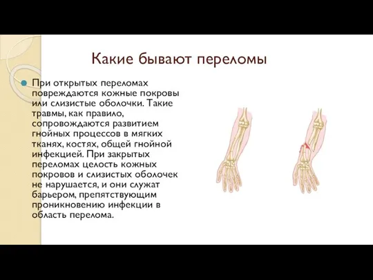 Какие бывают переломы При открытых переломах повреждаются кожные покровы или слизистые оболочки.