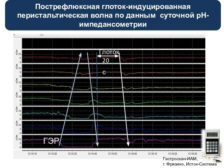 Пострефлюксная глоток-индуцированная перистальтическая волна по данным суточной рН-импедансометрии Гастроскан-ИАМ, г. Фрязино, Исток-Система ГЭР Глоток 20с