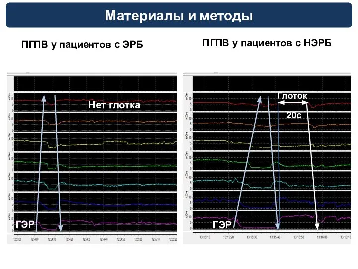 ПГПВ у пациентов с ЭРБ ПГПВ у пациентов с НЭРБ 20с ГЭР ГЭР Нет глотка Глоток