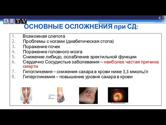 ОСНОВНЫЕ ОСЛОЖНЕНИЯ при СД: Возможная слепота Проблемы с ногами (диабетическая стопа) Поражение