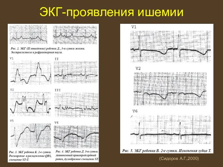 ЭКГ-проявления ишемии (Сидоров А.Г.,2000)