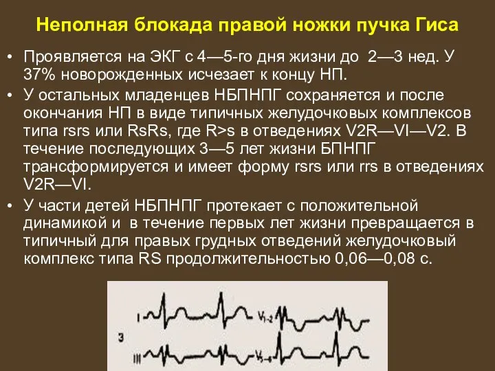 Неполная блокада правой ножки пучка Гиса Проявляется на ЭКГ с 4—5-го дня