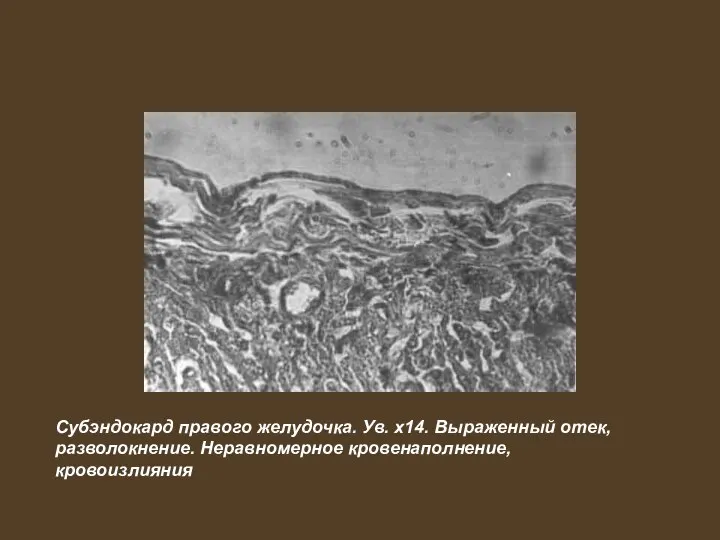 Субэндокард правого желудочка. Ув. x14. Выраженный отек, разволокнение. Неравномерное кровенаполнение, кровоизлияния