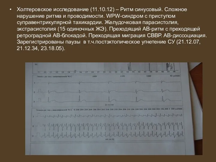 Холтеровское исследование (11.10.12) – Ритм синусовый. Сложное нарушение ритма и проводимости. WPW-синдром