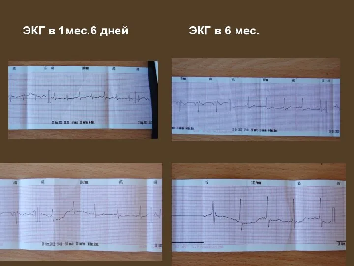 ЭКГ в 1мес.6 дней ЭКГ в 6 мес.