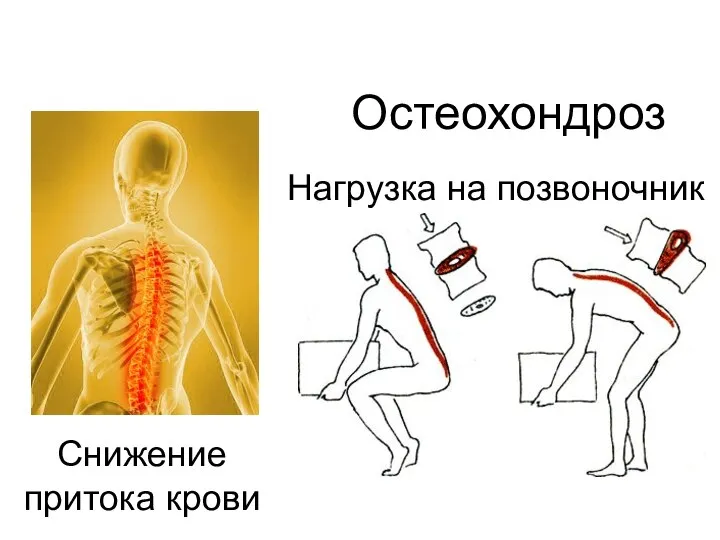 Остеохондроз Нагрузка на позвоночник Снижение притока крови