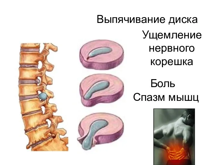 Ущемление нервного корешка Боль Спазм мышц Выпячивание диска