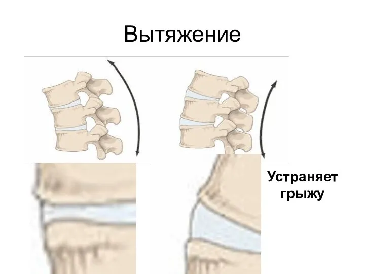 Вытяжение Устраняет грыжу