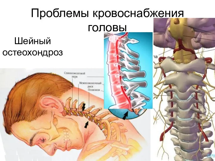 Проблемы кровоснабжения головы Шейный остеохондроз