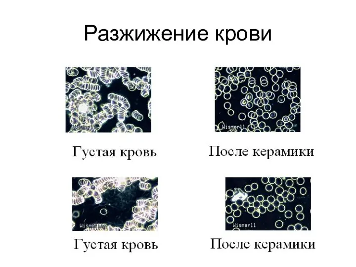 Разжижение крови