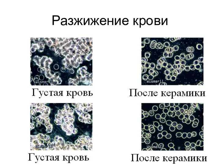 Разжижение крови