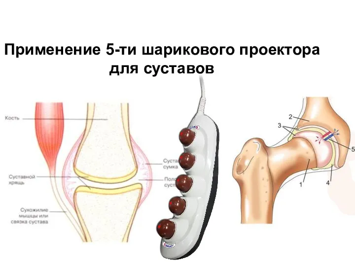 Применение 5-ти шарикового проектора для суставов