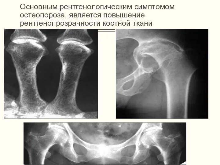 Основным рентгенологическим симптомом остеопороза, является повышение рентгенопрозрачности костной ткани