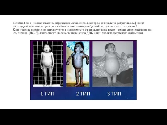 Болезнь Гоше - наследственное нарушение метаболизма, которое возникает в результате дефицита глюкоцереброзидазы