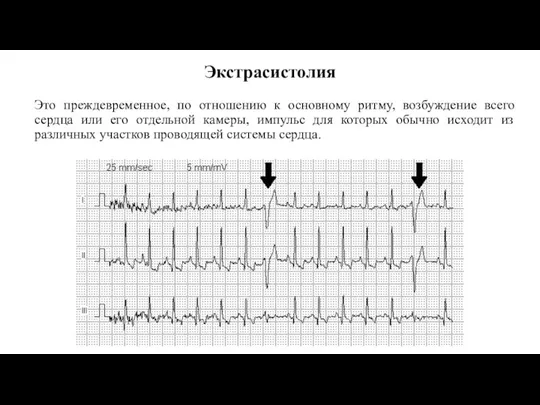 Экстрасистолия Это преждевременное, по отношению к основному ритму, возбуждение всего сердца или