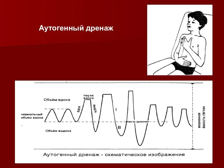 Аутогенный дренаж