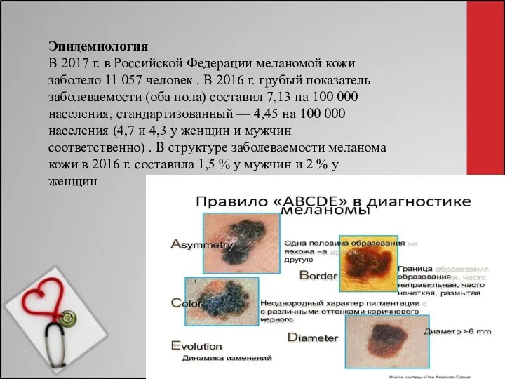 Эпидемиология В 2017 г. в Российской Федерации меланомой кожи заболело 11 057