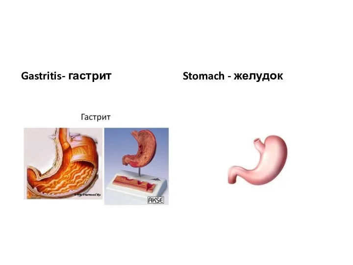 Gastritis- гастрит Stomach - желудок