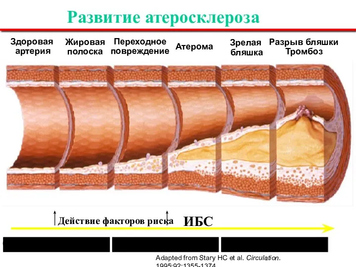 Развитие атеросклероза Здоровая артерия Жировая полоска Переходное повреждение Атерома Зрелая бляшка Разрыв