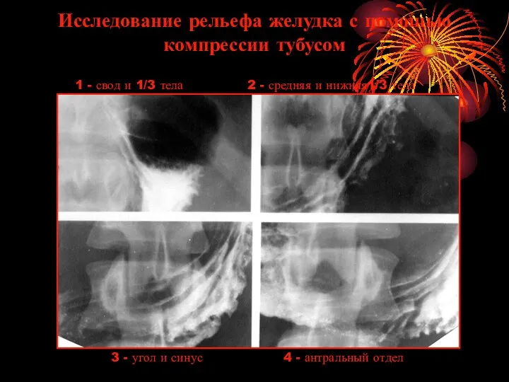 Исследование рельефа желудка с помощью компрессии тубусом 1 - свод и 1/3