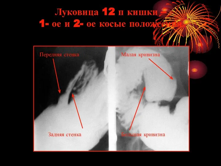 Луковица 12 п кишки – 1- ое и 2- ое косые положеения