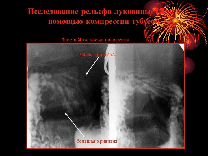 Исследование рельефа луковицы 12пк с помощью компрессии тубусом 1-ое и 2-ое косые