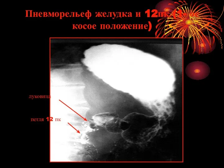 Пневморельеф желудка и 12пк (1- ое косое положение) луковица петля 12 пк