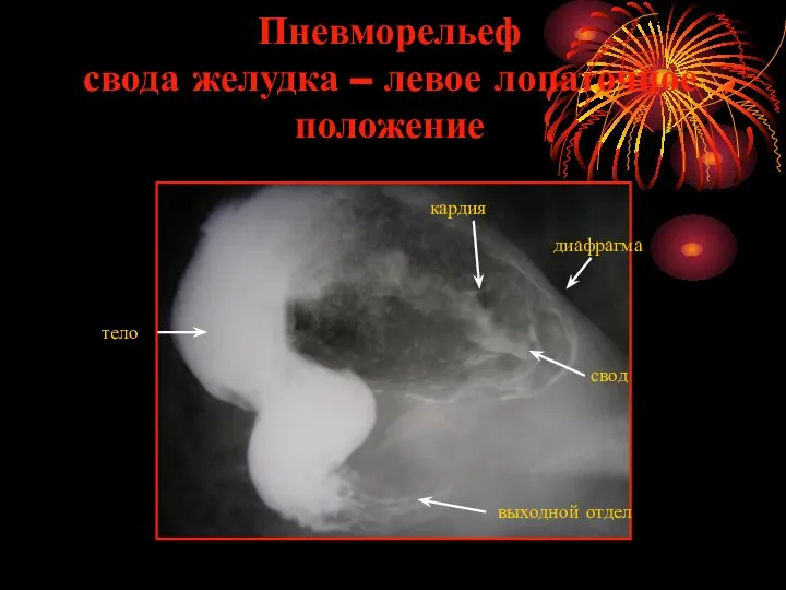 Пневморельеф свода желудка – левое лопаточное положение диафрагма выходной отдел тело свод кардия