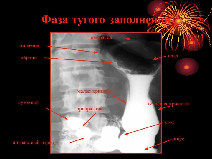 Фаза тугого заполнения свод кардия малая кривизна большая кривизна луковица привратник угол