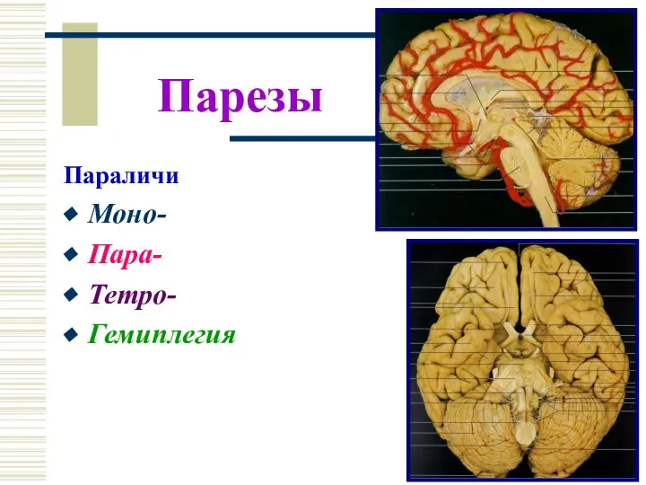 Парезы Параличи Моно- Пара- Тетро- Гемиплегия