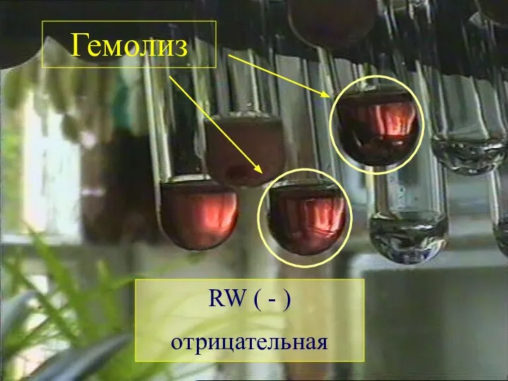 RW ( - ) отрицательная Гемолиз