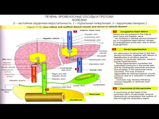ПЕЧЕНЬ: КРОВЕНОСНЫЕ СОСУДЫ И ПРОТОКИ. БОЛЕЗНИ (1 – застойная сердечная недостаточность. 2