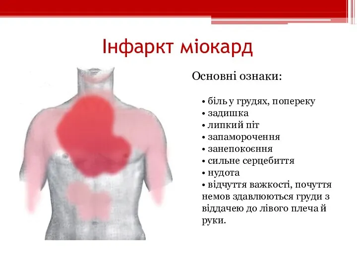 Інфаркт міокард Основні ознаки: • біль у грудях, попереку • задишка •