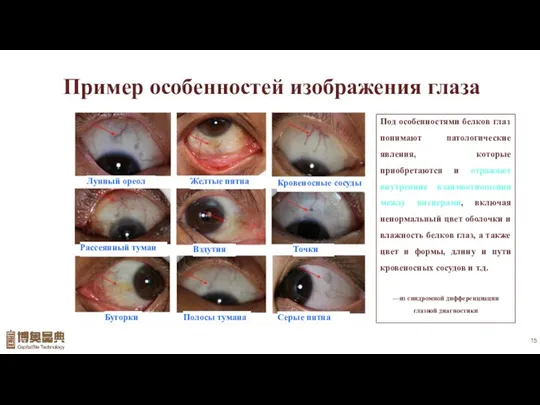 Пример особенностей изображения глаза Под особенностями белков глаз понимают патологические явления, которые