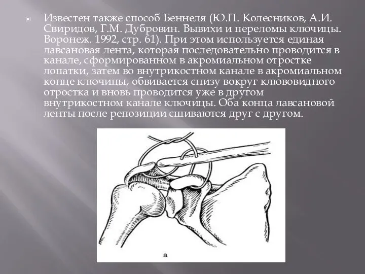 Известен также способ Беннеля (Ю.П. Колесников, А.И. Свиридов, Г.М. Дубровин. Вывихи и