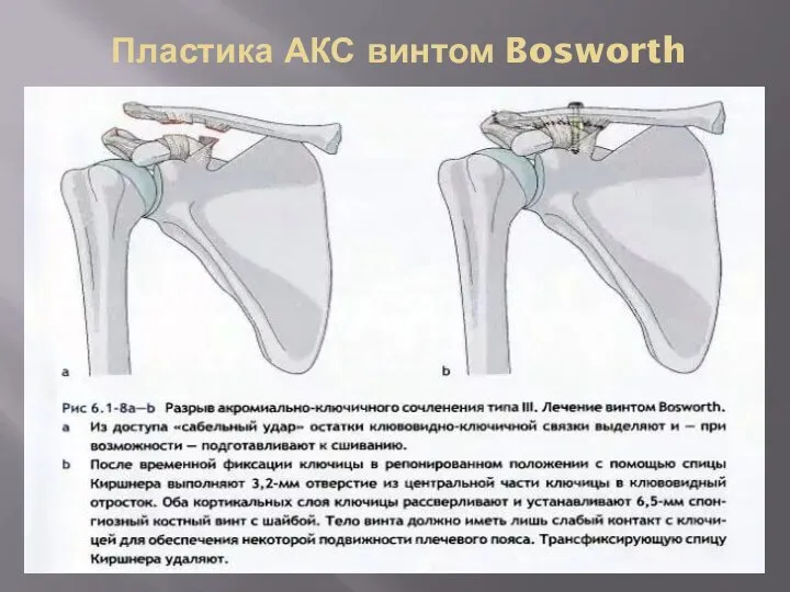 Пластика АКС винтом Bosworth