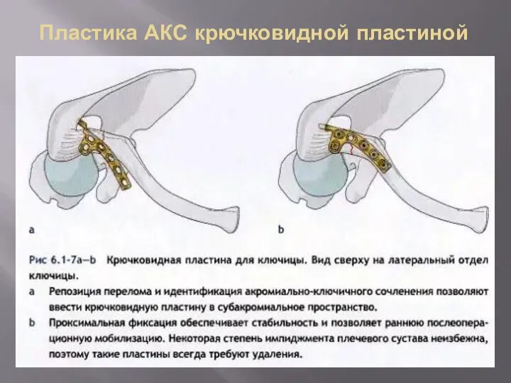 Пластика АКС крючковидной пластиной