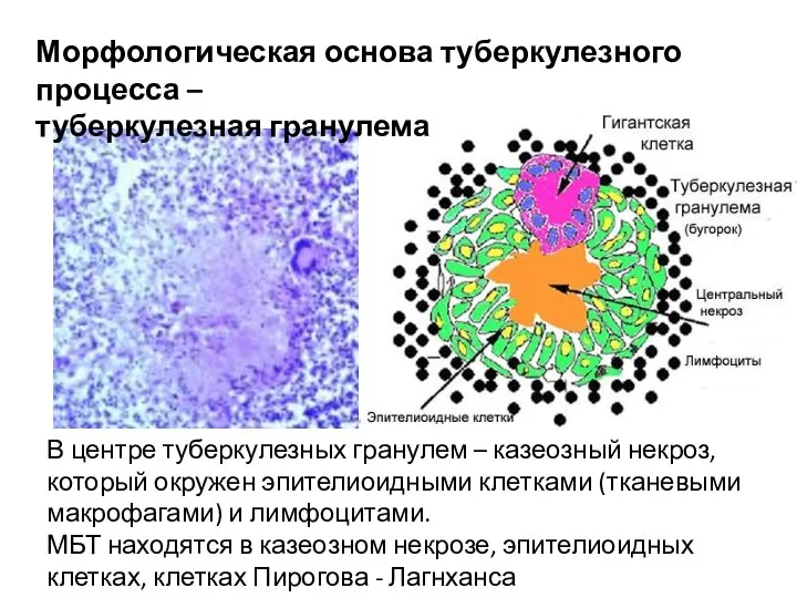 В центре туберкулезных гранулем – казеозный некроз, который окружен эпителиоидными клетками (тканевыми