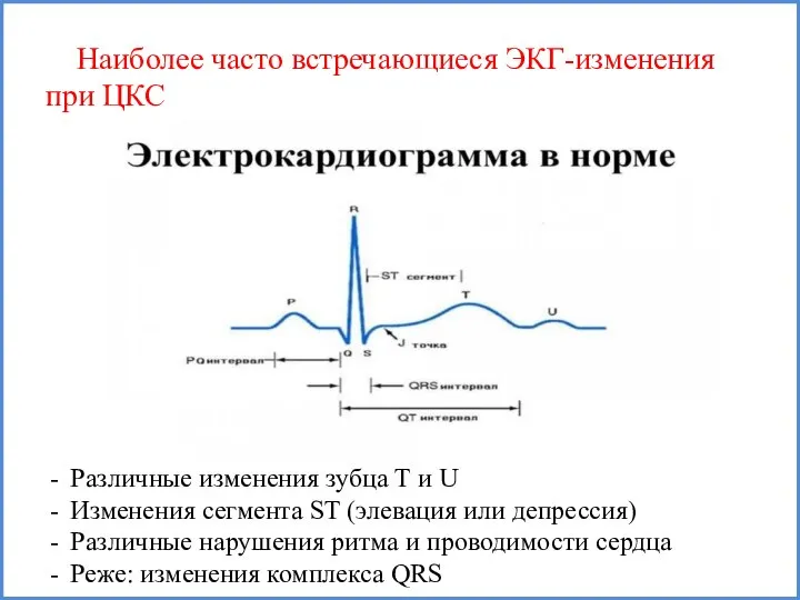 Различные изменения зубца Т и U Изменения сегмента ST (элевация или депрессия)