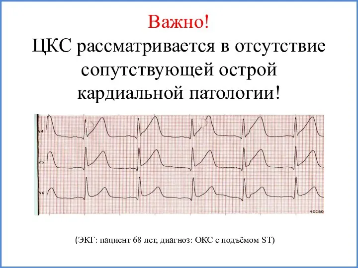 Важно! ЦКС рассматривается в отсутствие сопутствующей острой кардиальной патологии! (ЭКГ: пациент 68