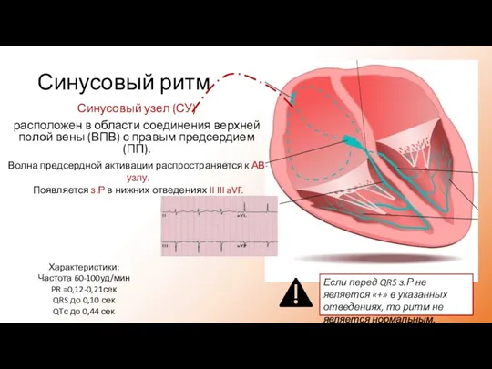 Синусовый ритм Синусовый узел (СУ) расположен в области соединения верхней полой вены