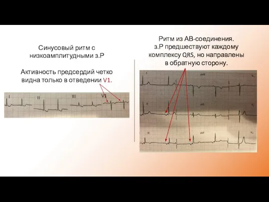 Синусовый ритм с низкоамплитудными з.Р Активность предсердий четко видна только в отведении