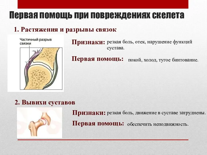 Первая помощь при повреждениях скелета 1. Растяжения и разрывы связок Признаки: резкая